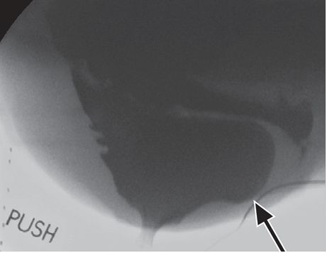 一文读懂:盆底功能障碍的影像学表现|临床实战