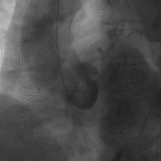 冠脉造影技术成熟不,跟我学技术分析从入门到精通