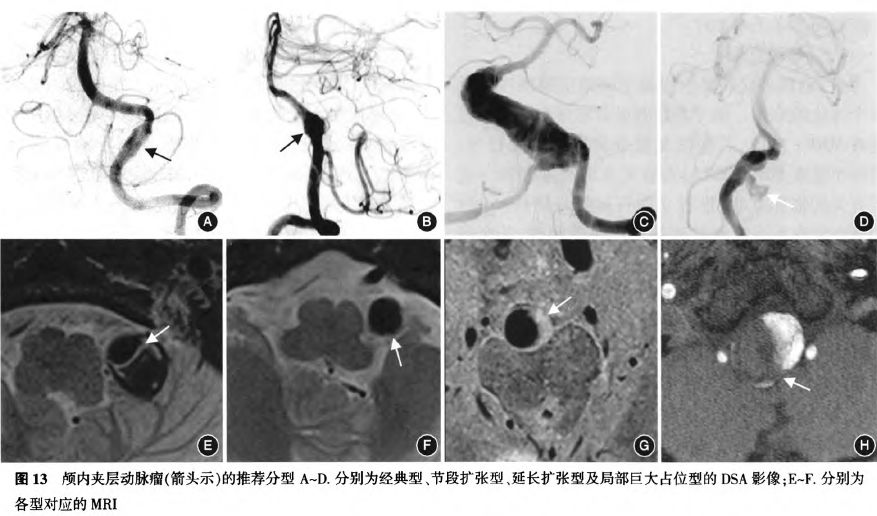 夜读：动脉的夹层，就仿佛是人生的夹缝