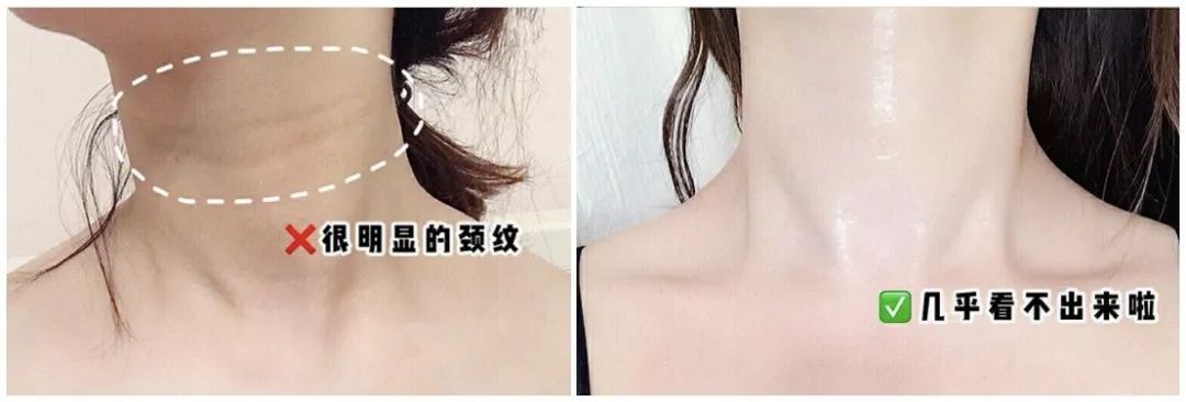 蛋白贴去皱,胶原蛋白颈纹贴