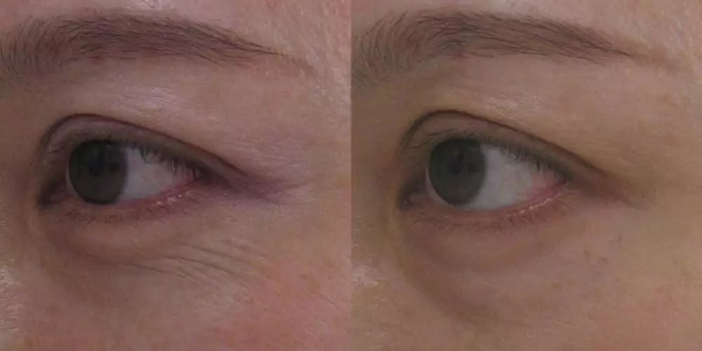 这款急救弹性蛋白贴，每天一片赶走干纹，还你天鹅美颈