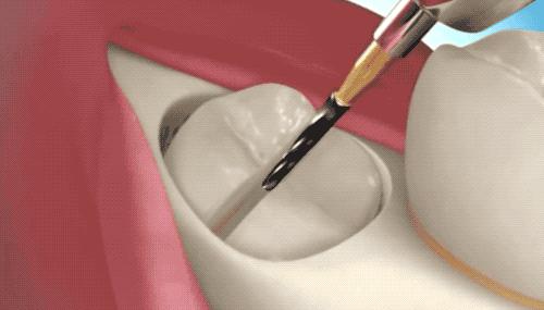 拔智齿的全过程科普,拔智齿细致操作过程