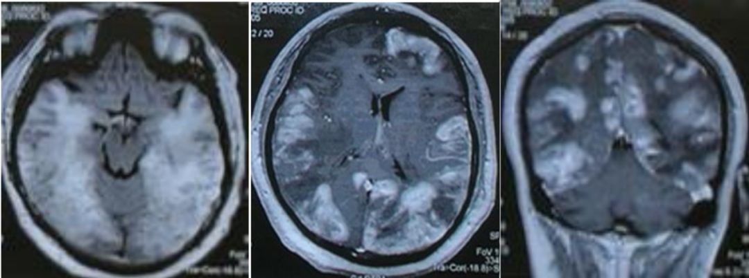 Whipple病、纹状体手、神经结节病、脱髓鞘假瘤丨3分钟读片·第16期