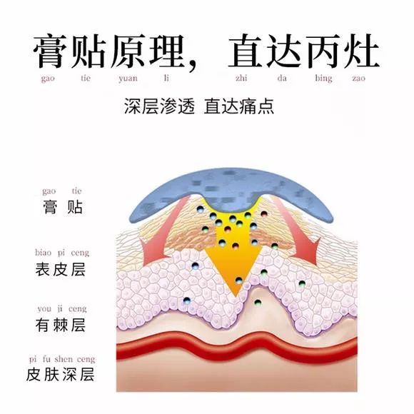 富贵包导致脖子筋痛用什么治疗,富贵包消除的最佳神器