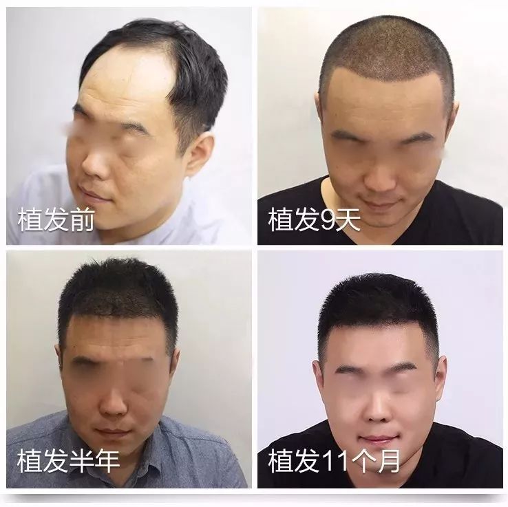 报道来了！28岁小伙“秃”成50岁？过年前抓紧……芜湖全面启动