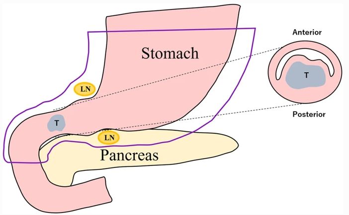 十二指肠腺癌累及胰腺算转移吗,罕见异位嗜铬细胞瘤1例