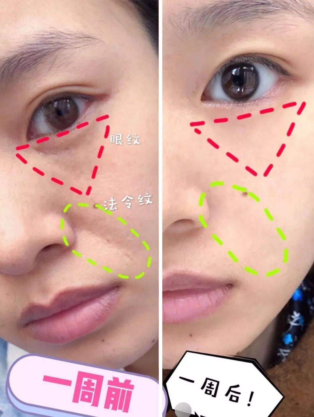 法令纹眼纹一个都逃不掉,法令纹和眼纹怎么才能有效改善