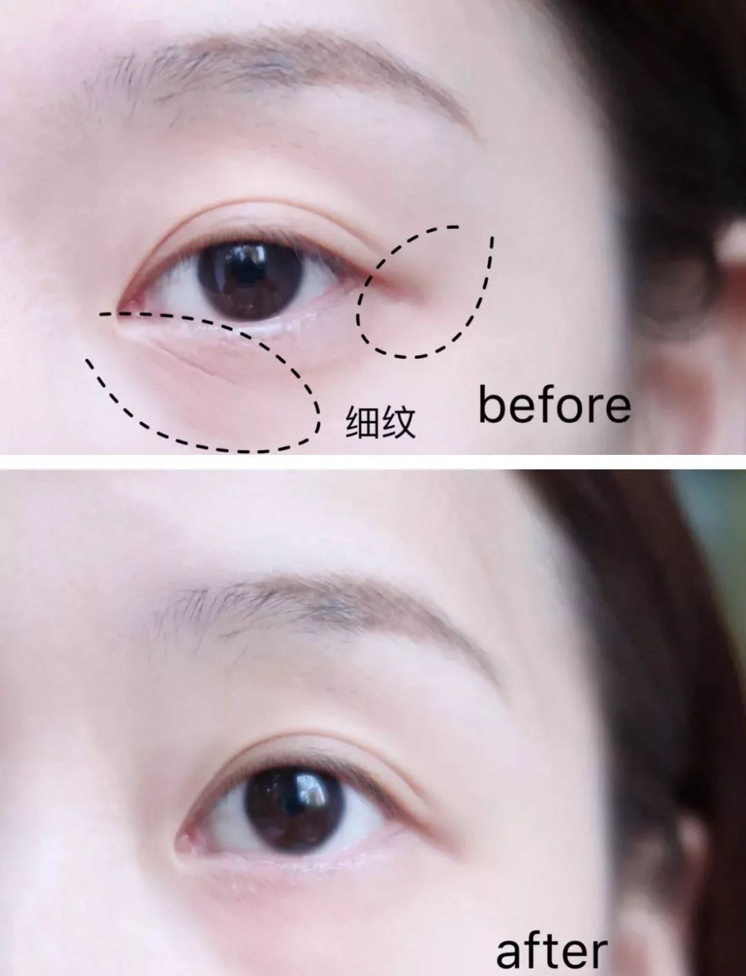 法令纹和眼纹怎么才能有效改善,法令纹贴眼贴有用吗