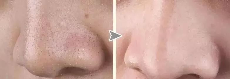 拒绝草莓鼻夹子夹出粉刺,拒绝草莓鼻毛孔粗大