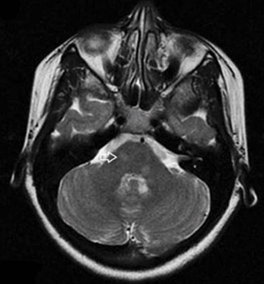 矛盾反应、Carney综合征、脑梗死、笑气中毒丨3分钟读片·第19期