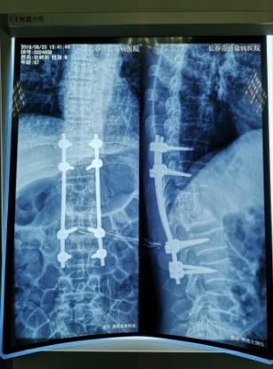 长春市传染病医院治疗皮肤结核,长春结核病医院院内感染