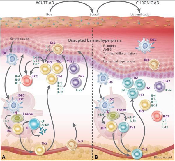 一招解决「七年之痒」!特应性皮炎药物Dupilumab步入中国,深度解读治疗中重度「难忍之痒」的全新利器|奇点深度