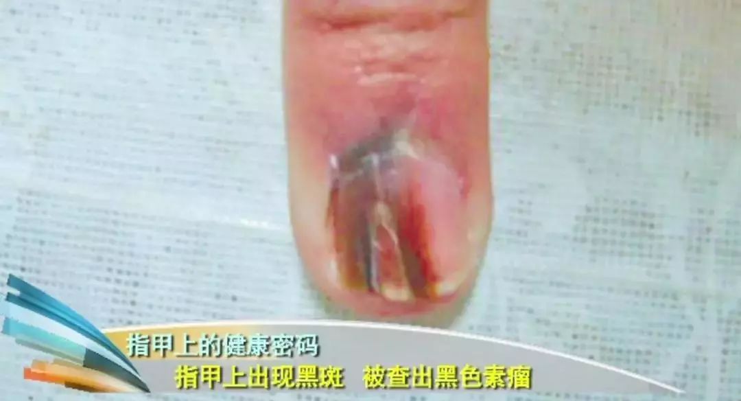 科普|指甲的状态反映了你身体的状况