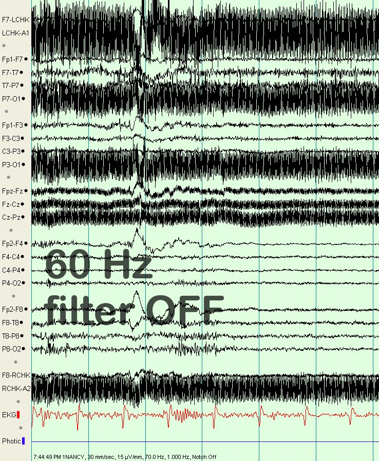 脑电图伪差图,脑电图伪差图谱