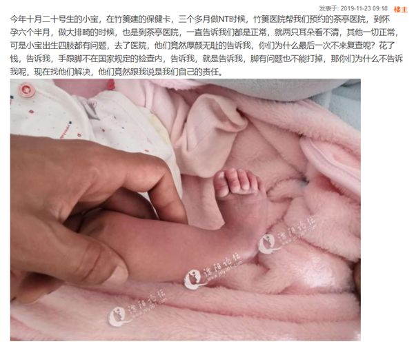 婴儿手脚畸形没查出来,新生儿手指畸形产检医院有责任么