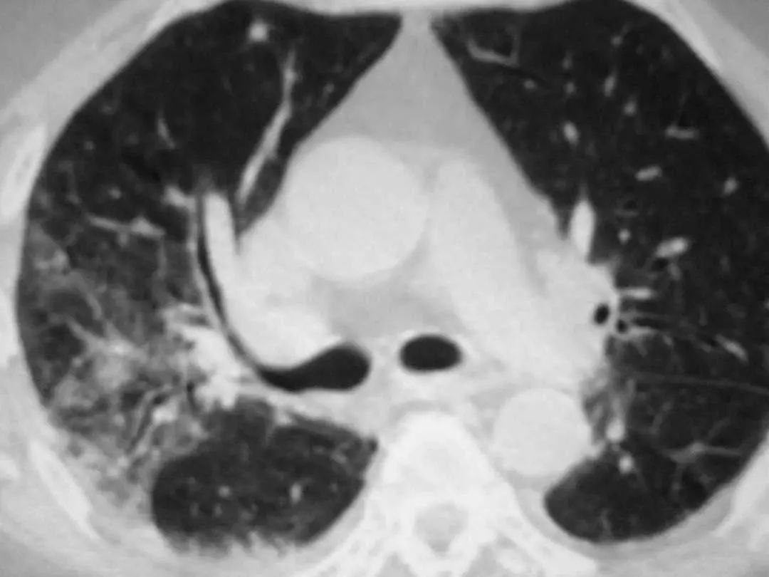 26张图，搞懂细菌性肺炎与病毒性肺炎