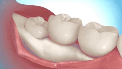 拔智齿的全过程科普,拔智齿细致操作过程