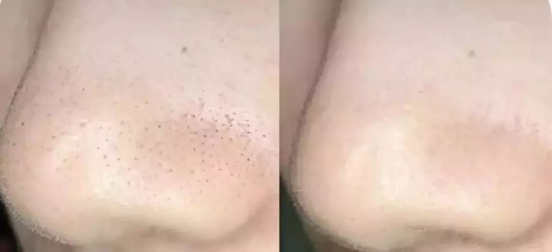 脸上搓下来很多泥,脸上搓出黑头