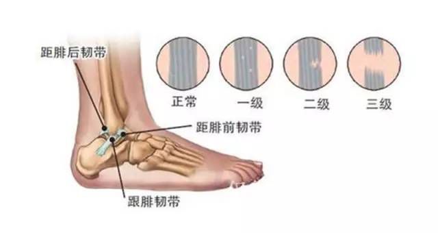 脚踝扭伤止痛消肿的中草药,脚踝扭伤肿了针灸快速消肿和止痛