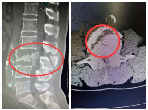 女生二楼摔下脊椎损伤,女孩秋千上摔下断脊椎