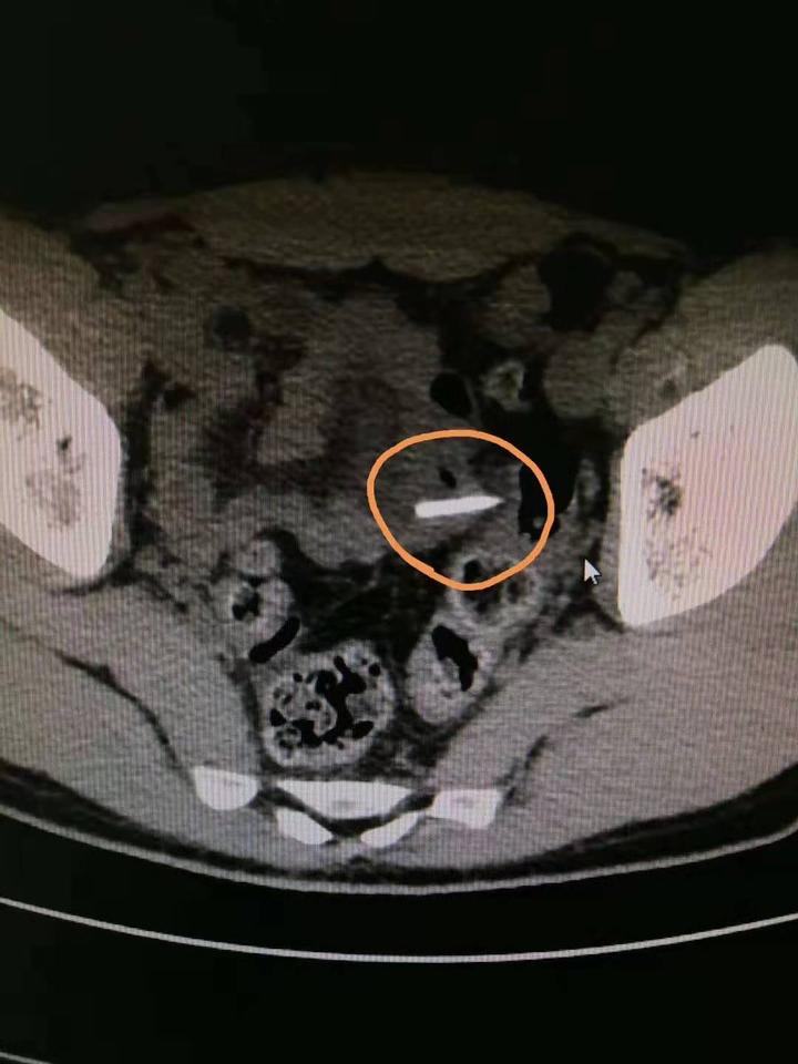 吃甲鱼肚子疼有什么危害,吃甲鱼肚子疼是中毒了吗