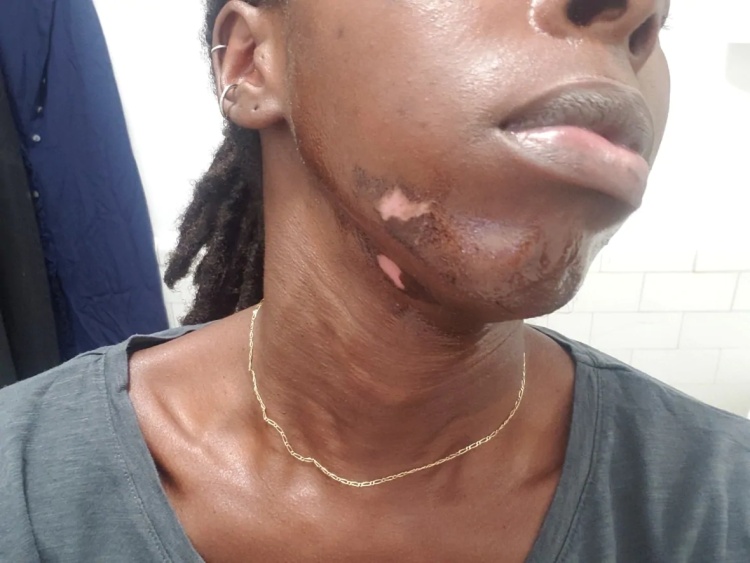 多伦多女子激光脱毛，只因一个签名被毁容也投诉无门