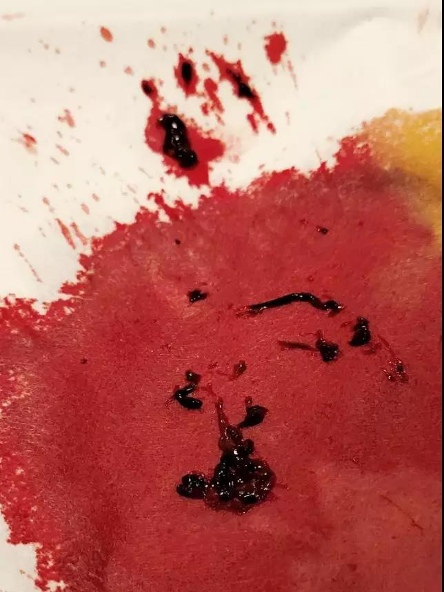 肺栓塞的抢救,三甲医院肺栓塞