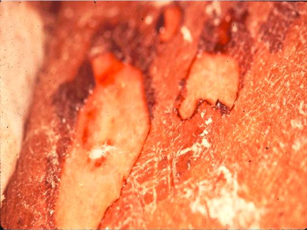 高热患儿出现充血性丘疹是什么病,儿童红斑狼疮病例