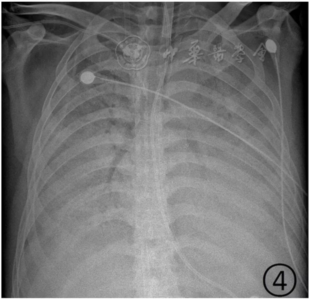 新冠肺炎影像演变过程,新冠肺炎胸部影像学特点有哪些