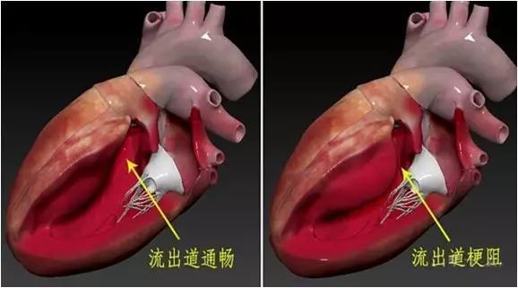 扩张型心肌病用什么消融,梗阻性肥厚性心肌病开胸手术恢复