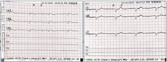 一度房室传导阻滞是怎么得的,三度房室传导阻滞最简单看法