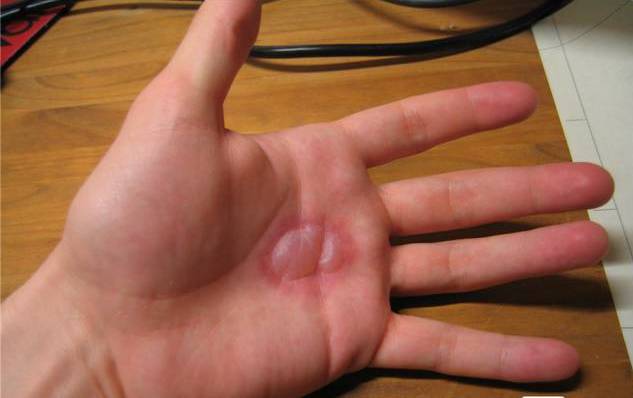 儿童开水烫伤急救处理,被开水烫伤怎么办最快最有效