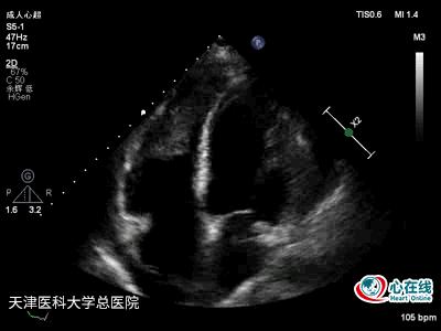 超声心动图发现赘生物,超声心动图检查结果疑似赘生物