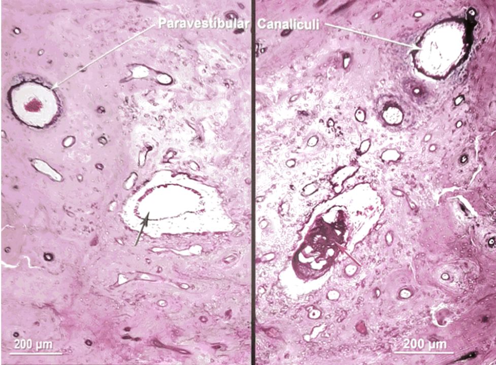 22张图，细说梅尼埃病的组织病理学特点丨“晕”筹帷幄