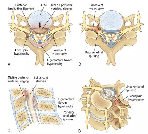 三维显微镜治颈椎病,脊髓型颈椎病3d模拟手术