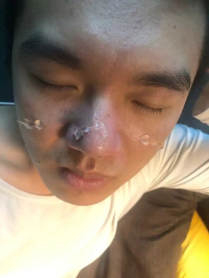 去除鼻子黑头视频大全,如何去除鼻子上的黑头12岁孩子