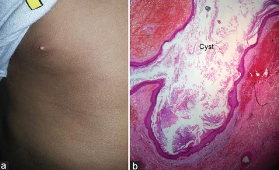 六个月宝宝粟丘疹,婴儿长粟丘疹是因为母乳吗