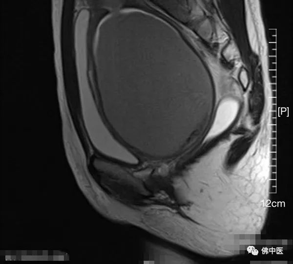 【高超】改写“石女”命运！佛中医妇科实施高难度罕见阴道成形术