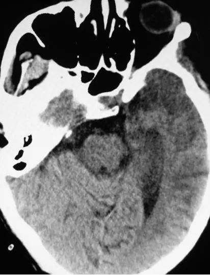 低血糖频发的症状及原因,反复低血糖病例