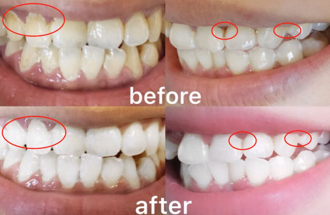 牙龈肿了出血口臭牙黄用什么牙膏,牙龈上火牙膏