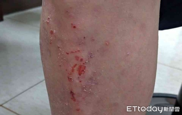 皮肤痒红疙瘩湿疹怎么治疗,湿疹红斑发痒怎么消除