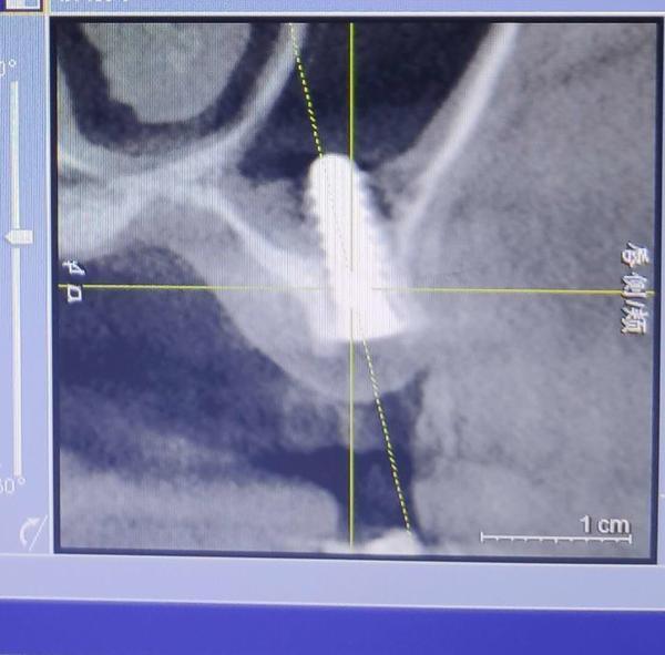 丹东种牙坑人吗,在私人诊所种牙靠谱吗