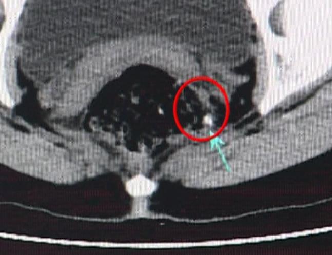 女士长了痔疮,女子得痔疮痛不欲生