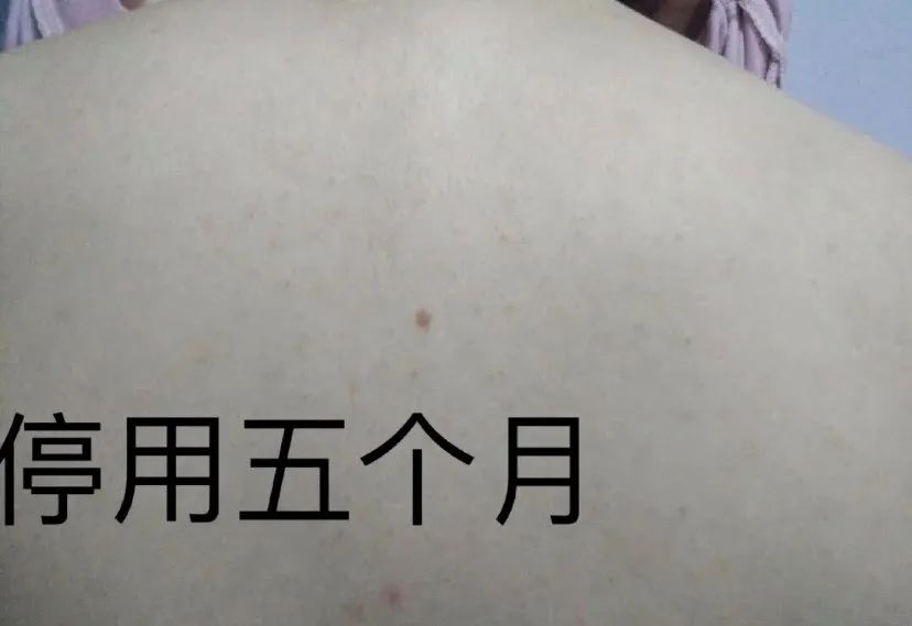 日本绿瓶的祛痘喷雾叫什么,清爽型祛痘喷雾