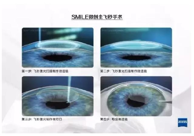 全飞秒4.0,全飞秒助您开启清晰新视野