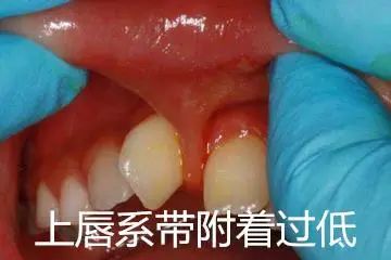 儿童换牙后牙齿长得不齐怎么办,换牙出现双排牙不齐怎么办