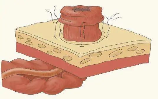 老人结肠癌晚期做了造口,76岁老人造口手术