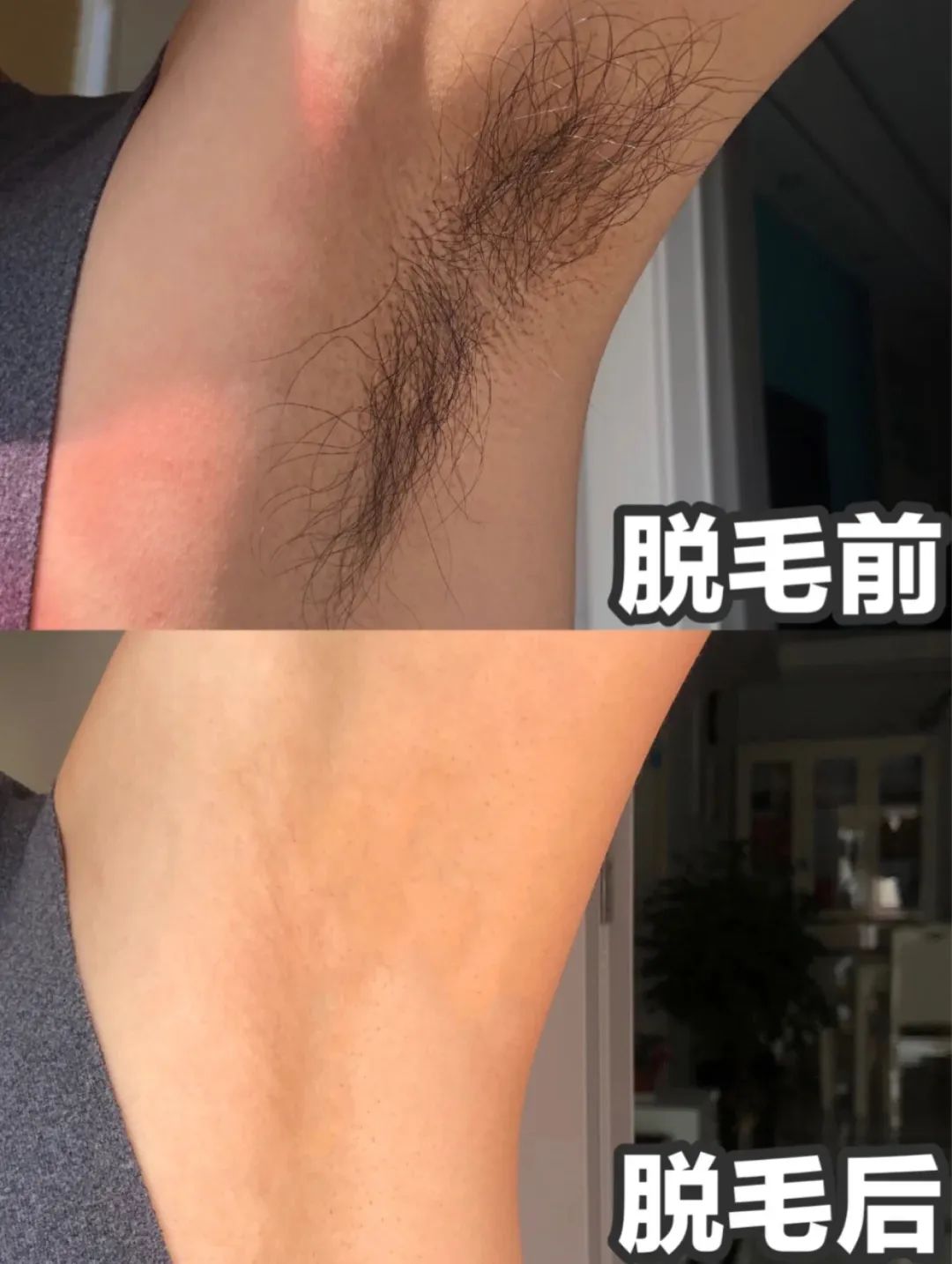 光滑无暇|黑丑的“毛裤腿”，用它，10分钟“脱”得一干二净，肌肤光滑细腻