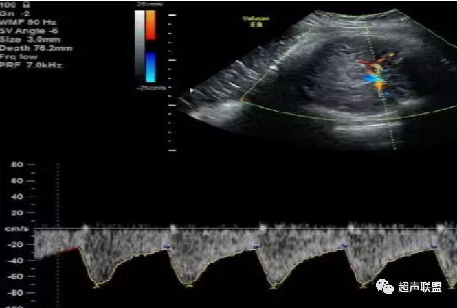 胎儿宫内窘迫如何判断,38周如何判断胎儿宫内窘迫或缺氧