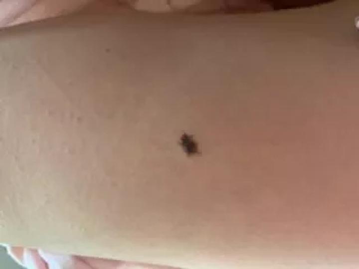 黑痣癌变的痣会很大吗,黑痣癌变一般是一个痣还是好多